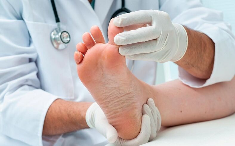 How and how to treat fungus on feet
