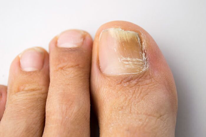 White spots and streaks on the nail plate-manifestations of onychomycosis