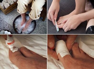 Steam your feet and apply urea cream on the nails infected by the fungus
