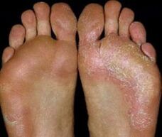 Mycosis on the feet