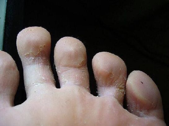 What does fungus look like on feet