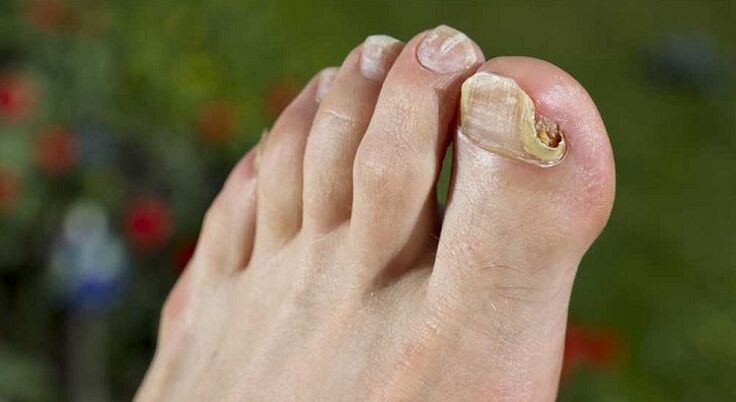 Fungus on the legs damages the nail plate