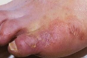 Manifestations of skin fungal infections on the legs