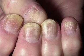 Nails changed by fungal infection