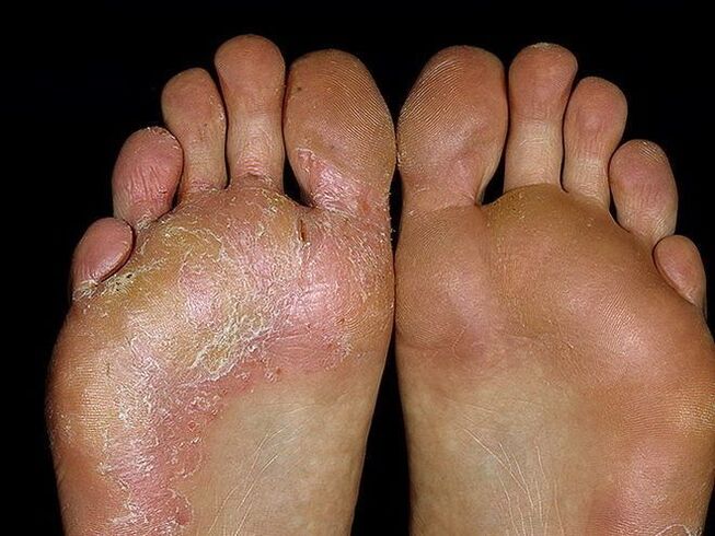 Symptoms of fungus on feet