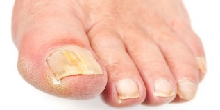flexible nails of the feet