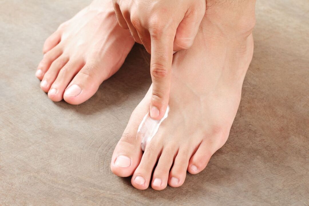 Treat fungus on the feet with ointment