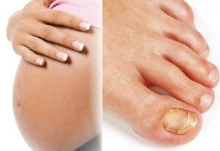 the fungus in the feet pregnancy