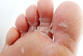 The fungus to the foot of the child