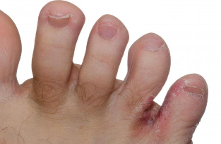 The athlete's foot
