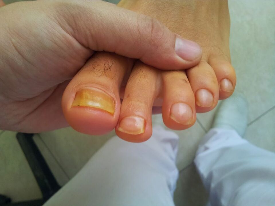 Fungus turns toenails yellow