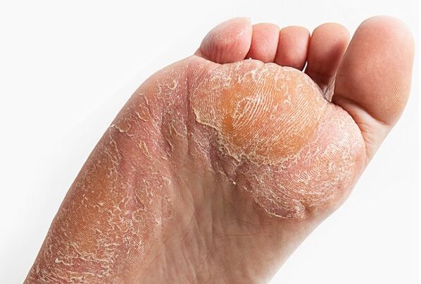 Skin peeling when infected with fungus