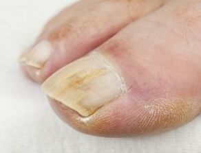 Antifungal drops should not be used when there is pus near the nail