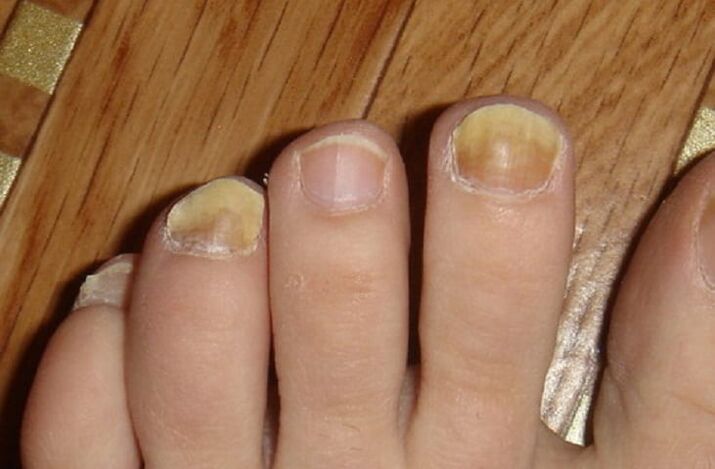 Fungal symptoms on the skin of the nails and feet