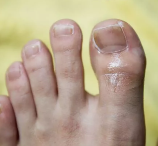 Fungus of the nail of the great toe
