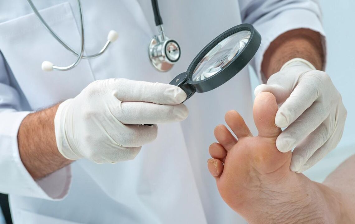 Doctor examining foot with fungus