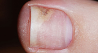 The symptoms of the initial phase of the onychomycosis