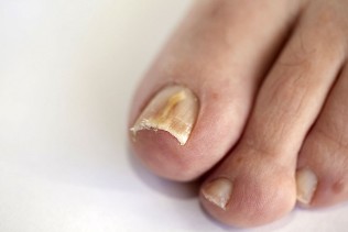 nail fungus on the feet