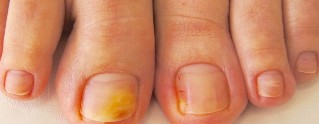 the nail fungus on legs symptoms