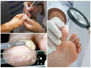 fungus of the skin of the foot diagnostic