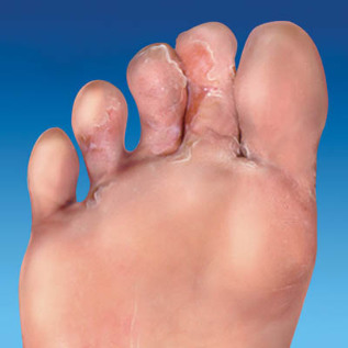 fungus of the skin of the foot