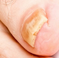 The nail affected by a fungus