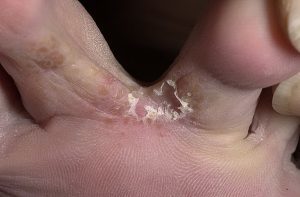 the form of foot fungus