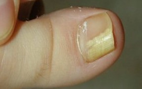 The mushroom of the nail