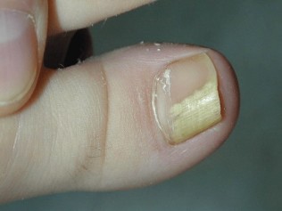 fungus on the thumb of the foot